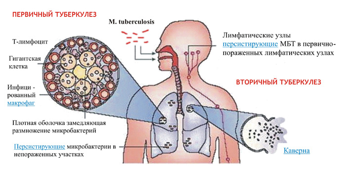 Механизмы возникновения и развития туберкулеза